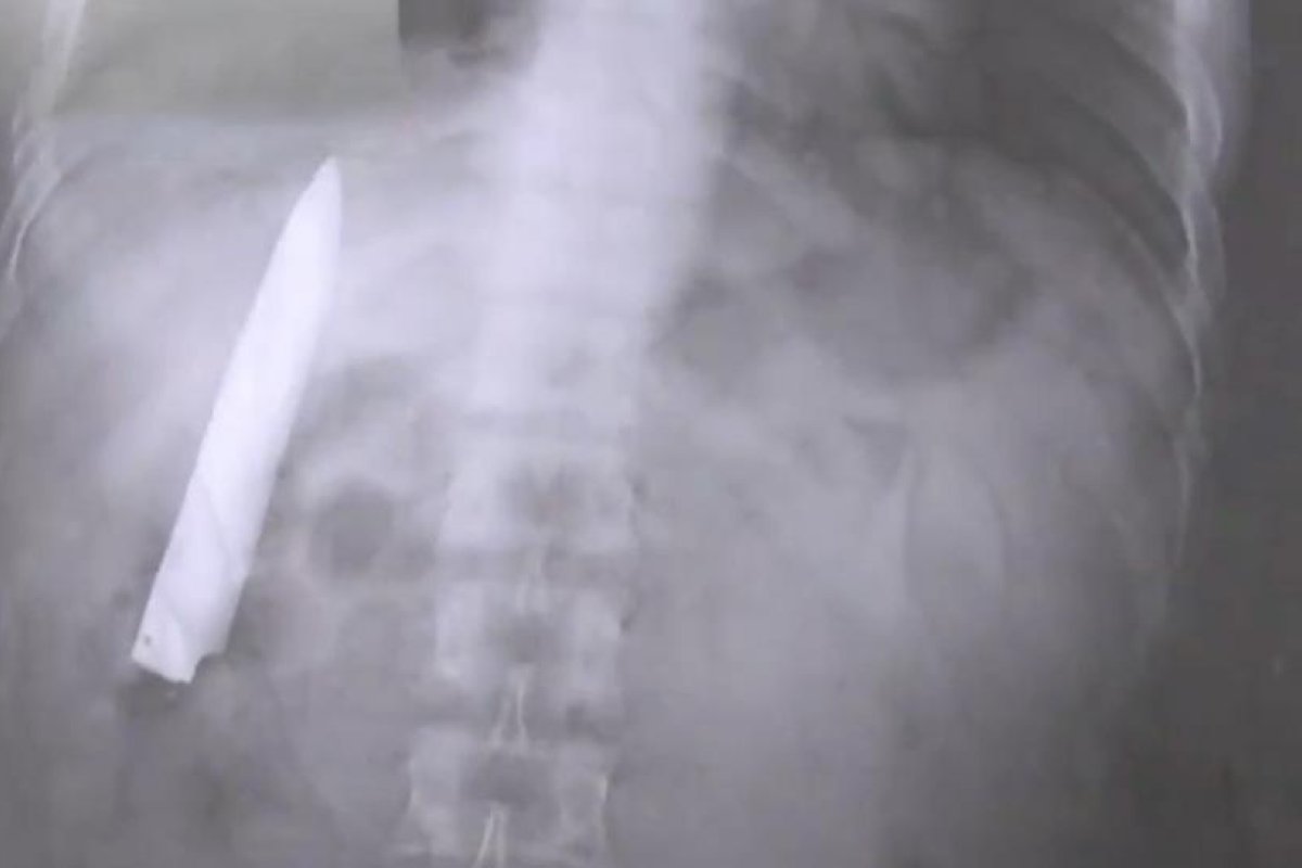 Un hombre descubre una hoja de cuchillo dentro de su torso 14 meses después de ser apuñalado