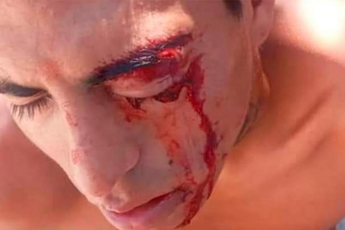 Un joven perdió su ojo izquierdo tras ser agredido con una gomera