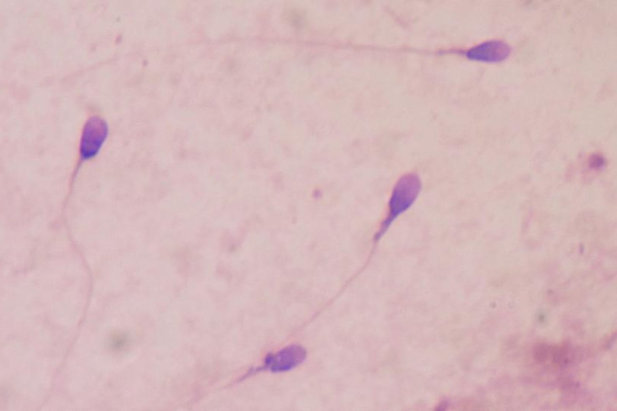 Donante de esperma con esquizofrenia miente sobre su educación, salud y aspecto físico y engendra 36 hijos