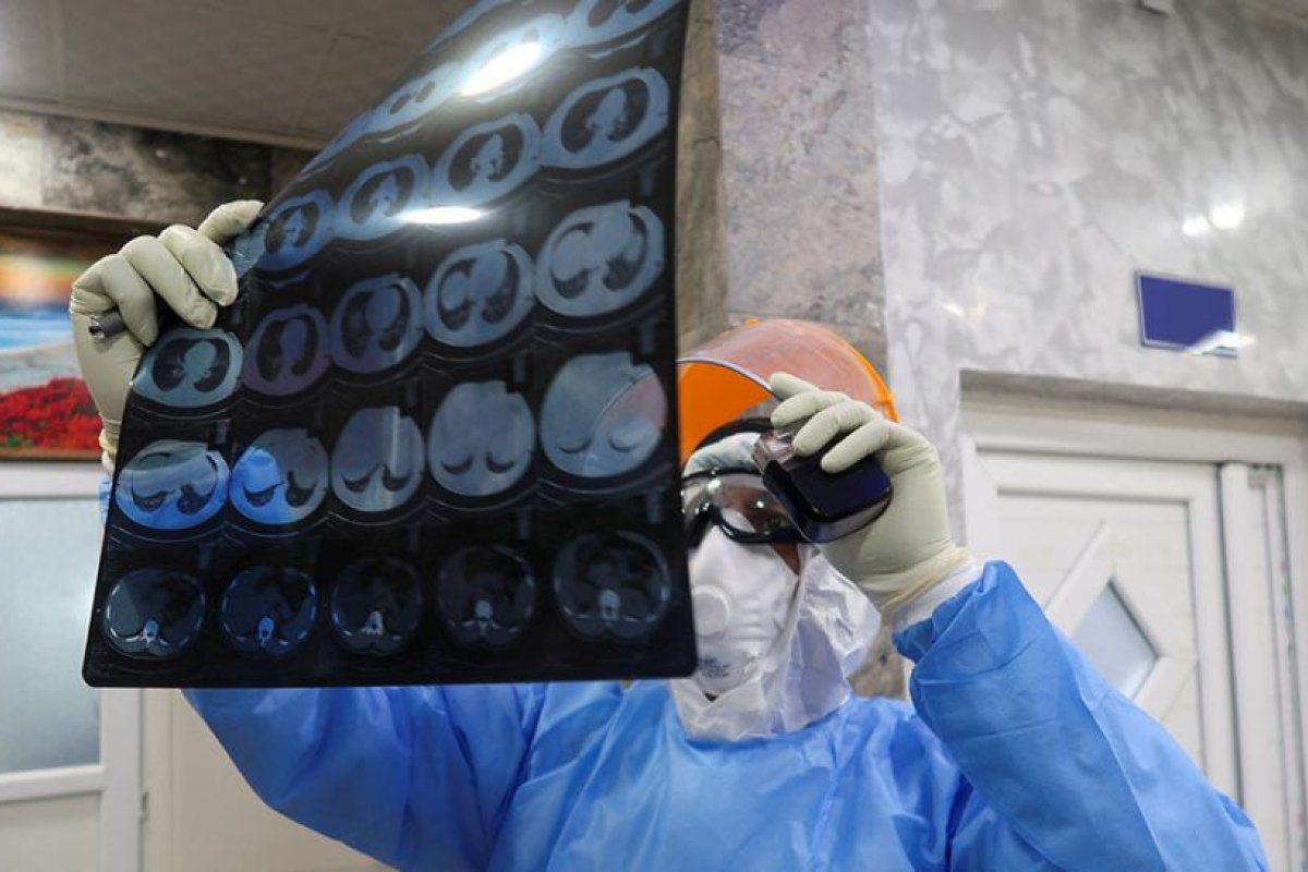 Inmunidad incierta: Un estadounidense que superó el covid-19 se contagió por segunda vez de forma más grave
