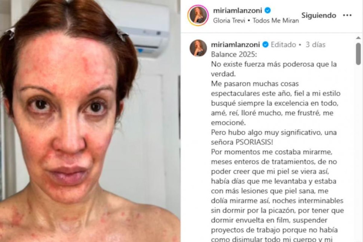 Miriam Lanzoni detalla su lucha contra la psoriasis en entrevista reveladora