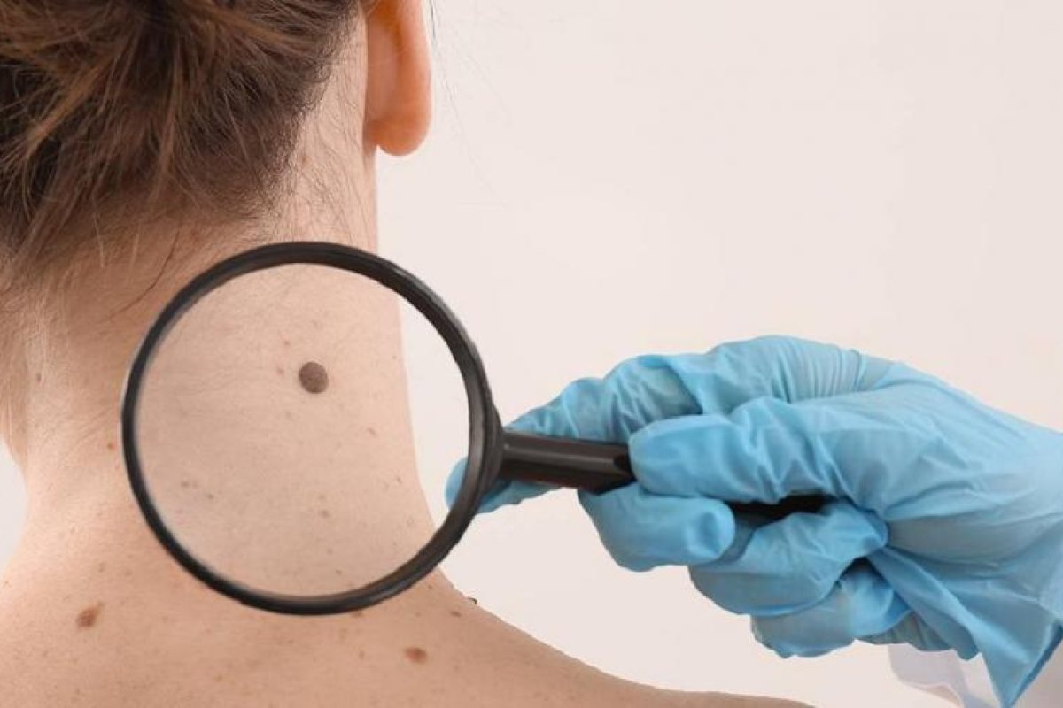 Guía para Proteger la Piel en Verano Durante Tratamientos Oncológicos
