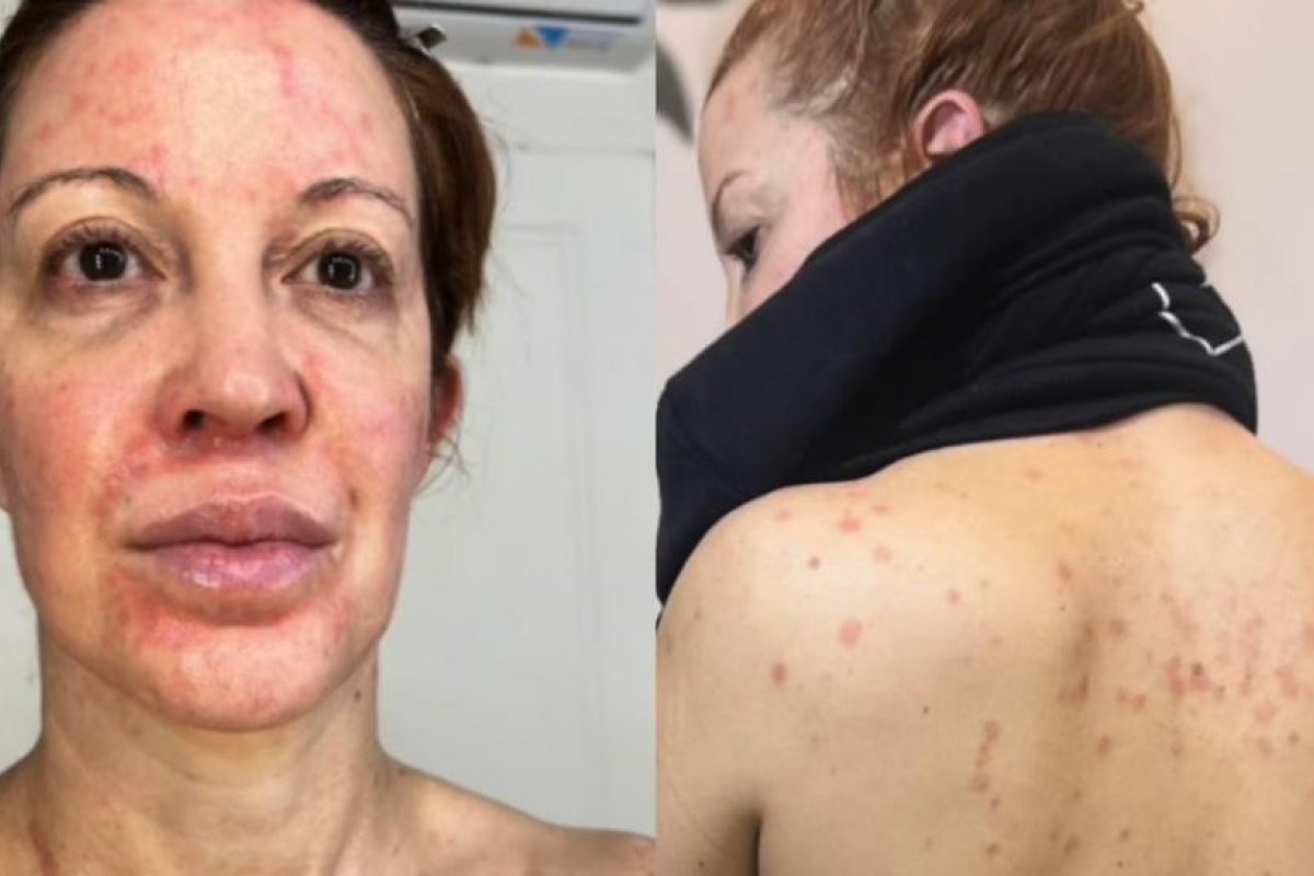 Miriam Lanzoni revela su lucha contra la psoriasis y su impacto emocional