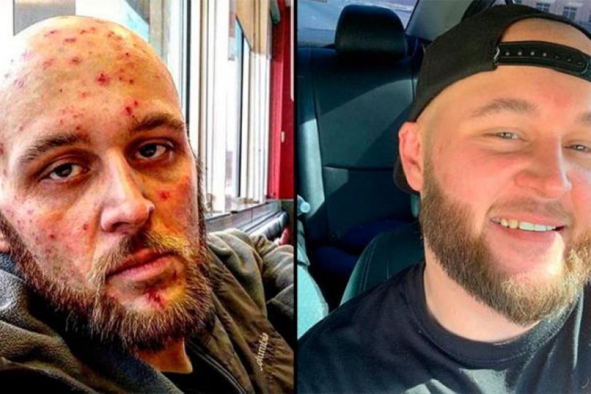 La increíble transformación de un adicto a la heroína al dejar las drogas