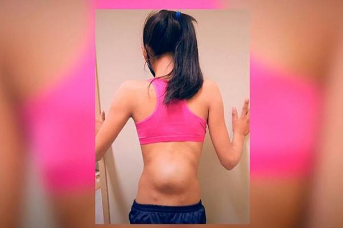 Tiene 13 años, le extirparon un tumor de la columna y pudo volver a caminar